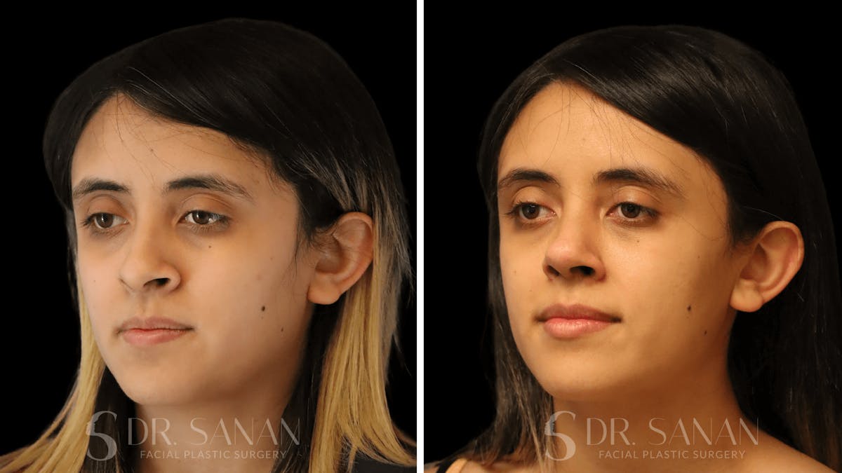 Rhinoplasty Before & After Gallery - Patient 339289 - Image 2