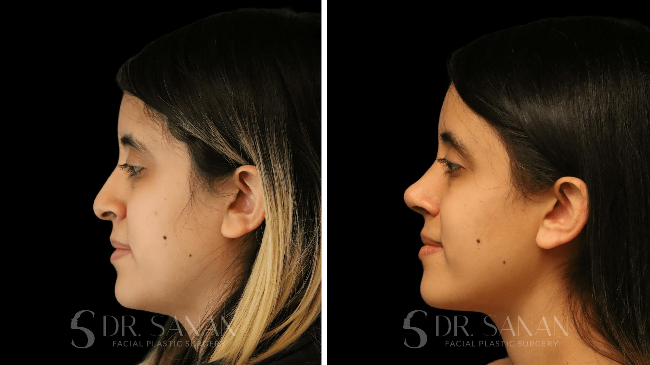 Rhinoplasty Before & After Gallery - Patient 339289 - Image 7