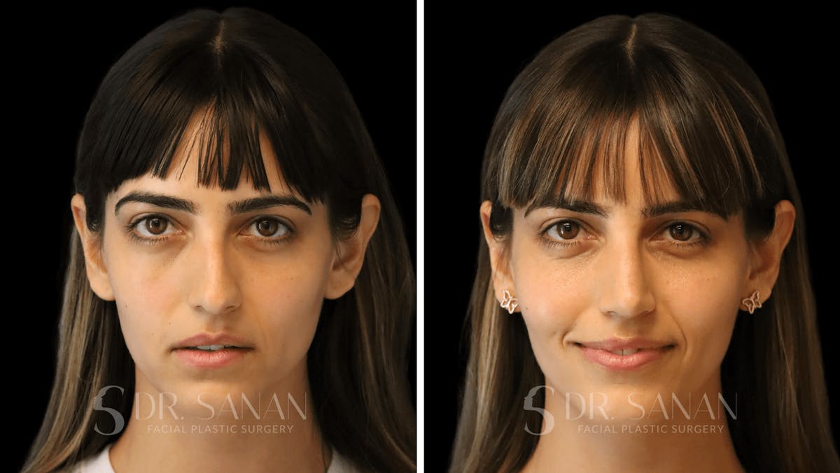 Rhinoplasty Before & After Gallery - Patient 126859 - Image 3