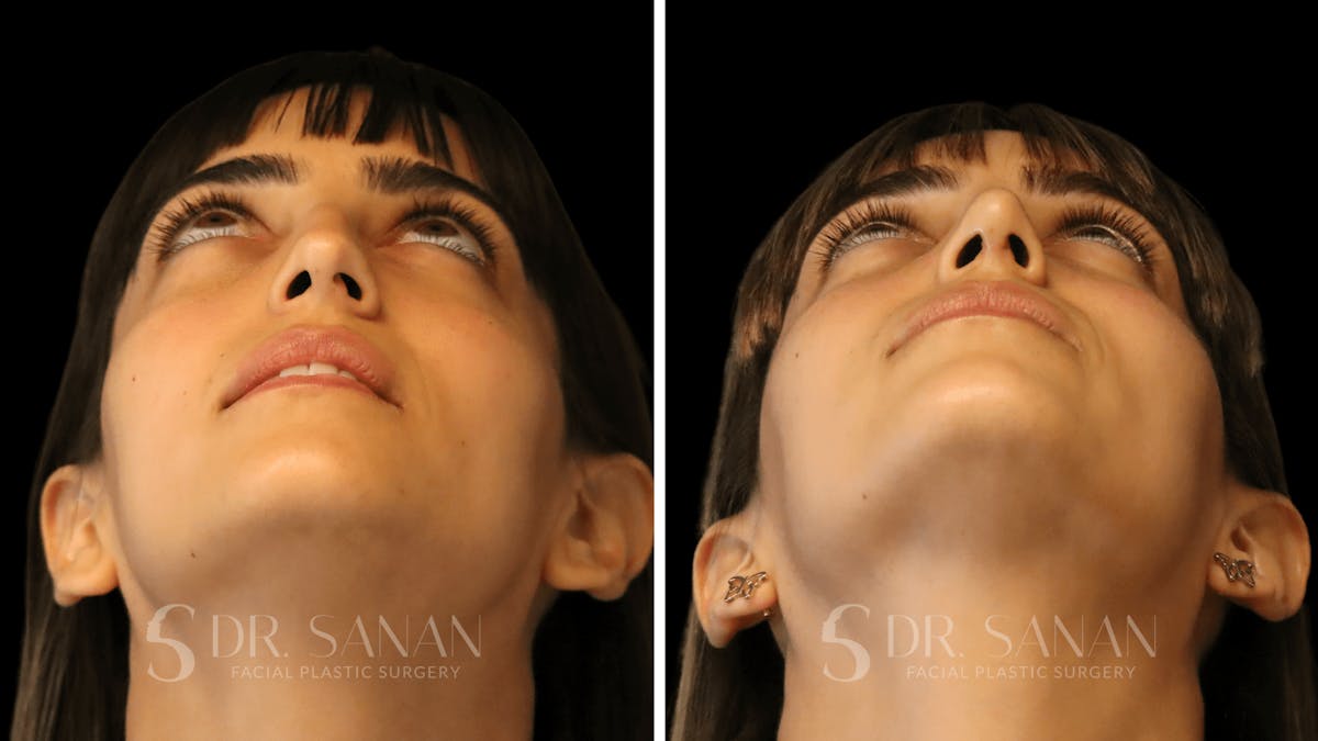 Rhinoplasty Before & After Gallery - Patient 126859 - Image 4