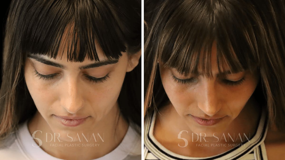 Rhinoplasty Before & After Gallery - Patient 126859 - Image 5