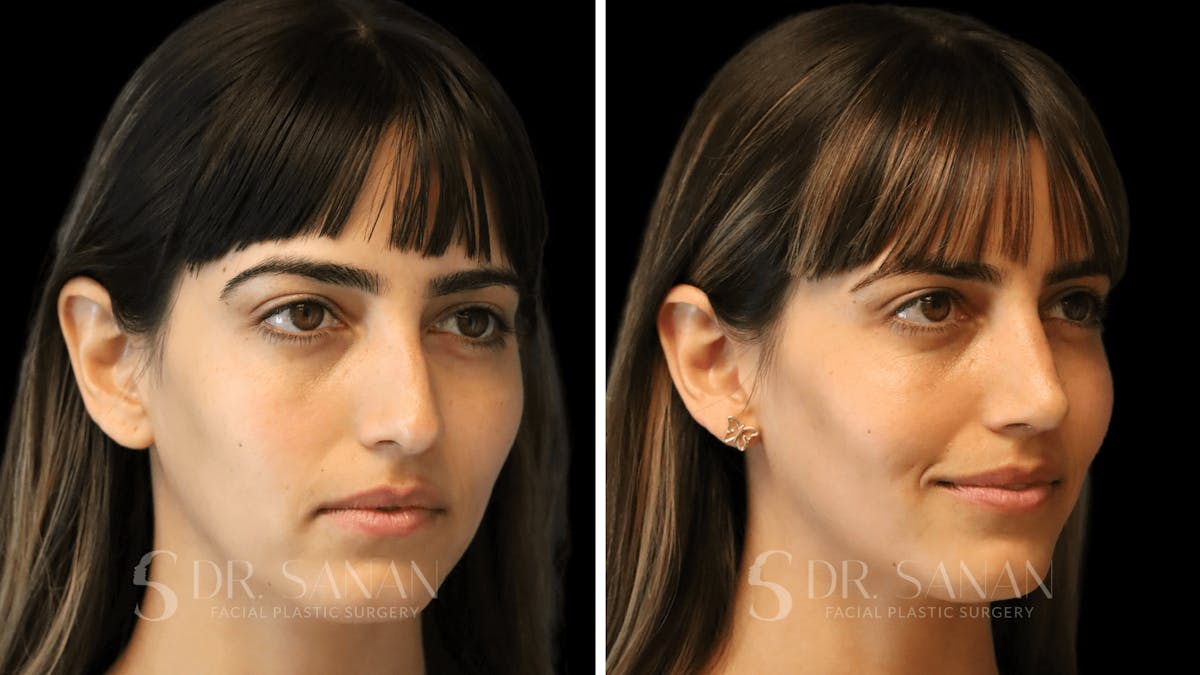 Rhinoplasty Before & After Gallery - Patient 126859 - Image 6