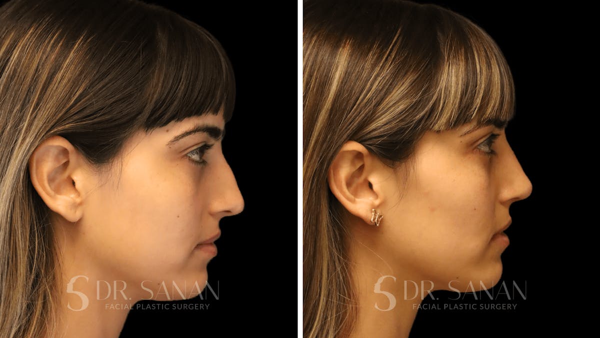 Rhinoplasty Before & After Gallery - Patient 126859 - Image 1