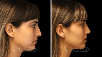 Rhinoplasty Before & After Gallery - Patient 126859 - Image 1