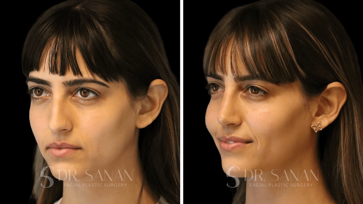 Rhinoplasty Before & After Gallery - Patient 126859 - Image 7