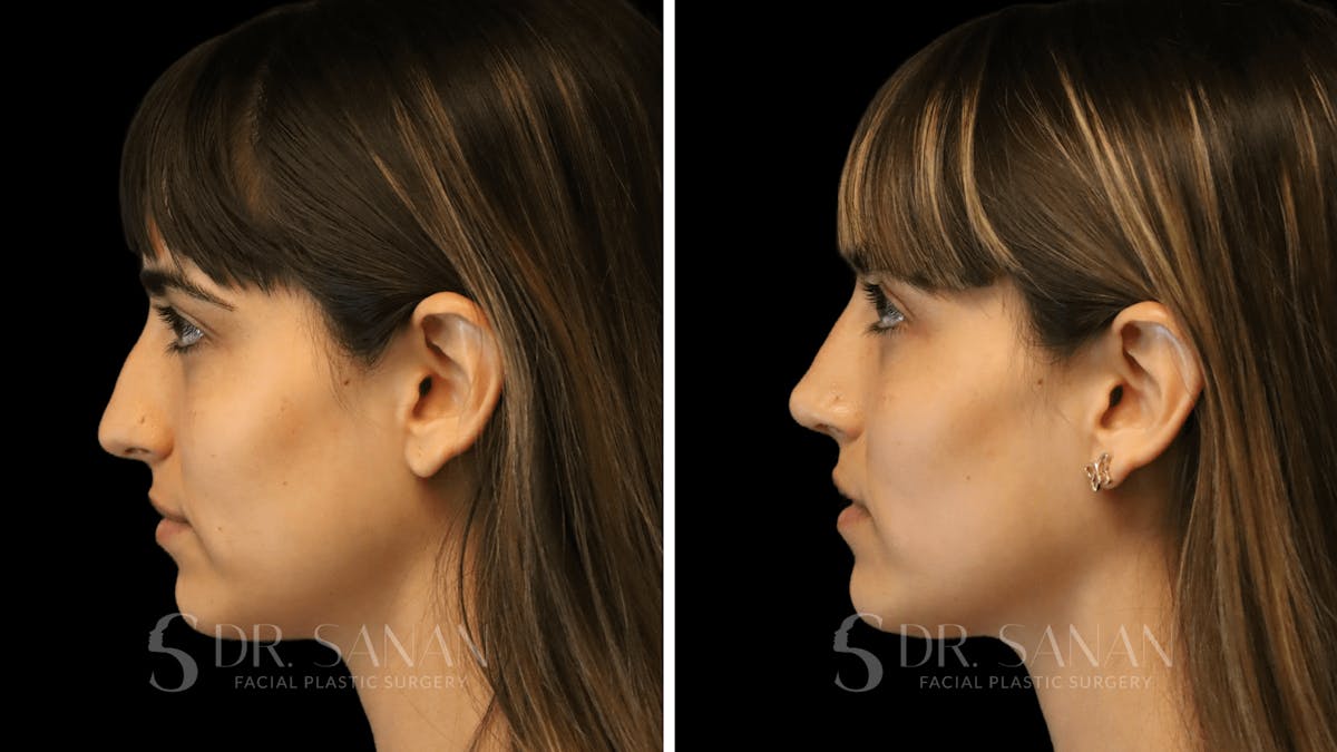 Rhinoplasty Before & After Gallery - Patient 126859 - Image 2