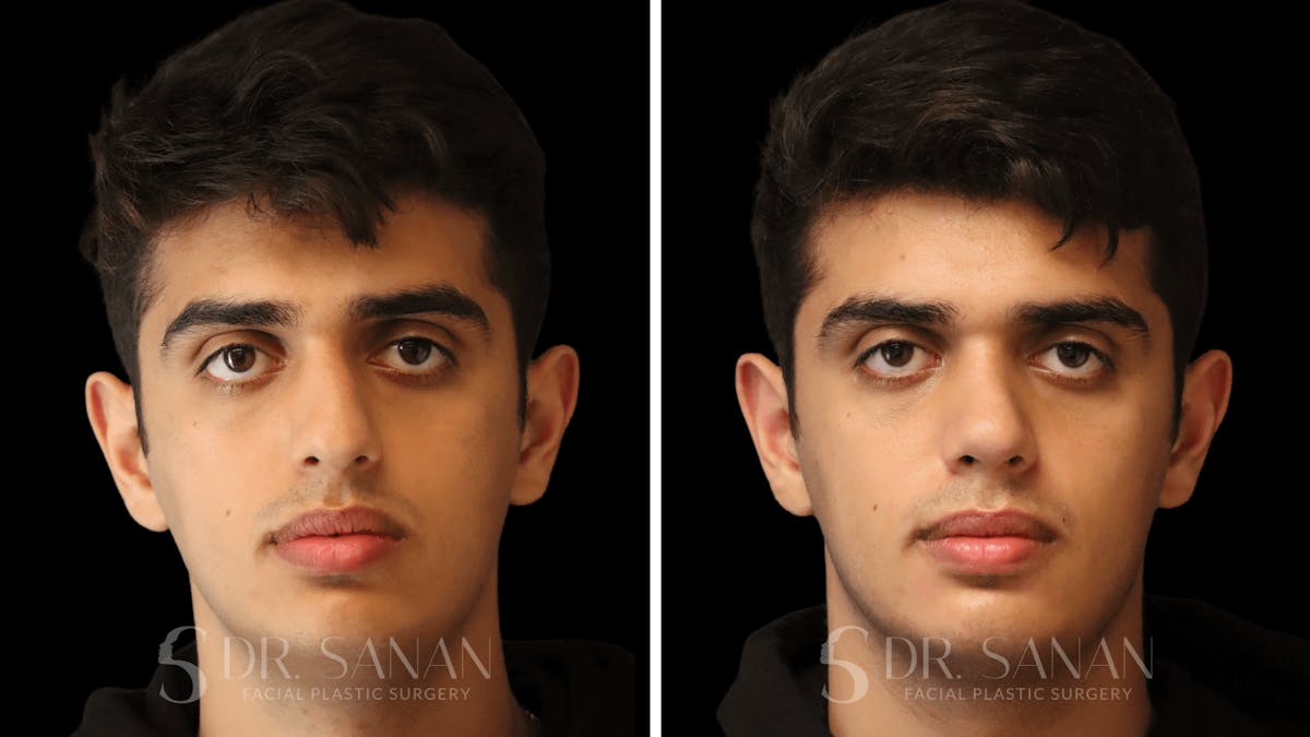 Rhinoplasty Before & After Gallery - Patient 207835 - Image 3