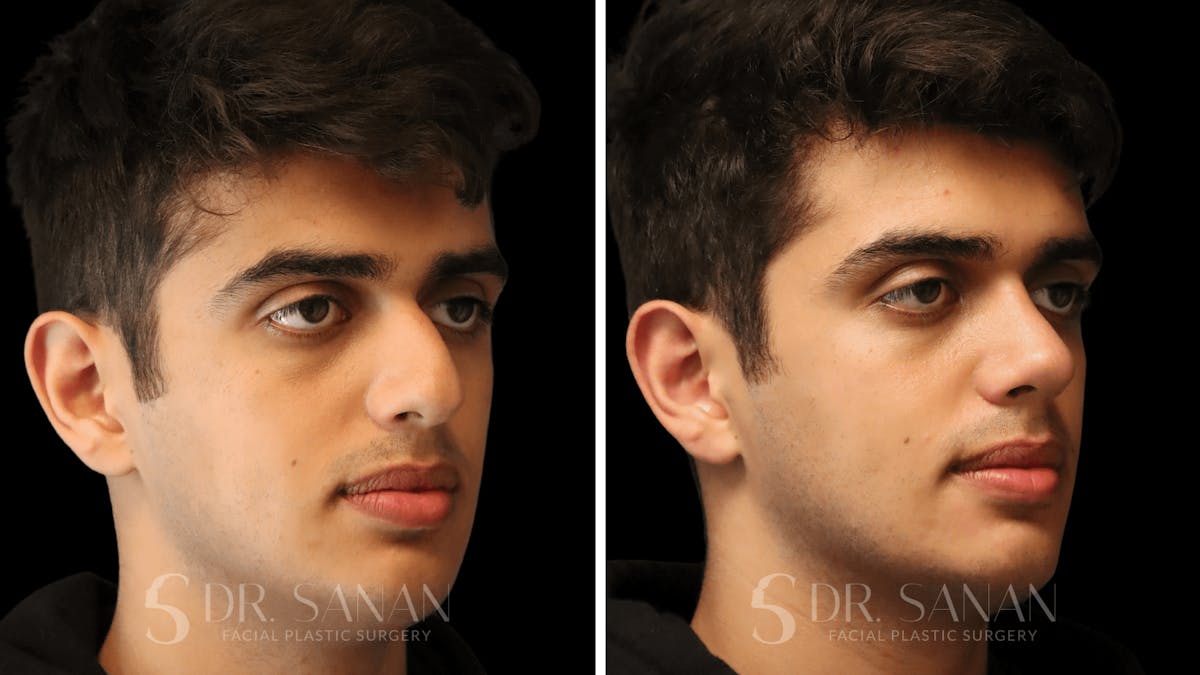 Rhinoplasty Before & After Gallery - Patient 207835 - Image 4