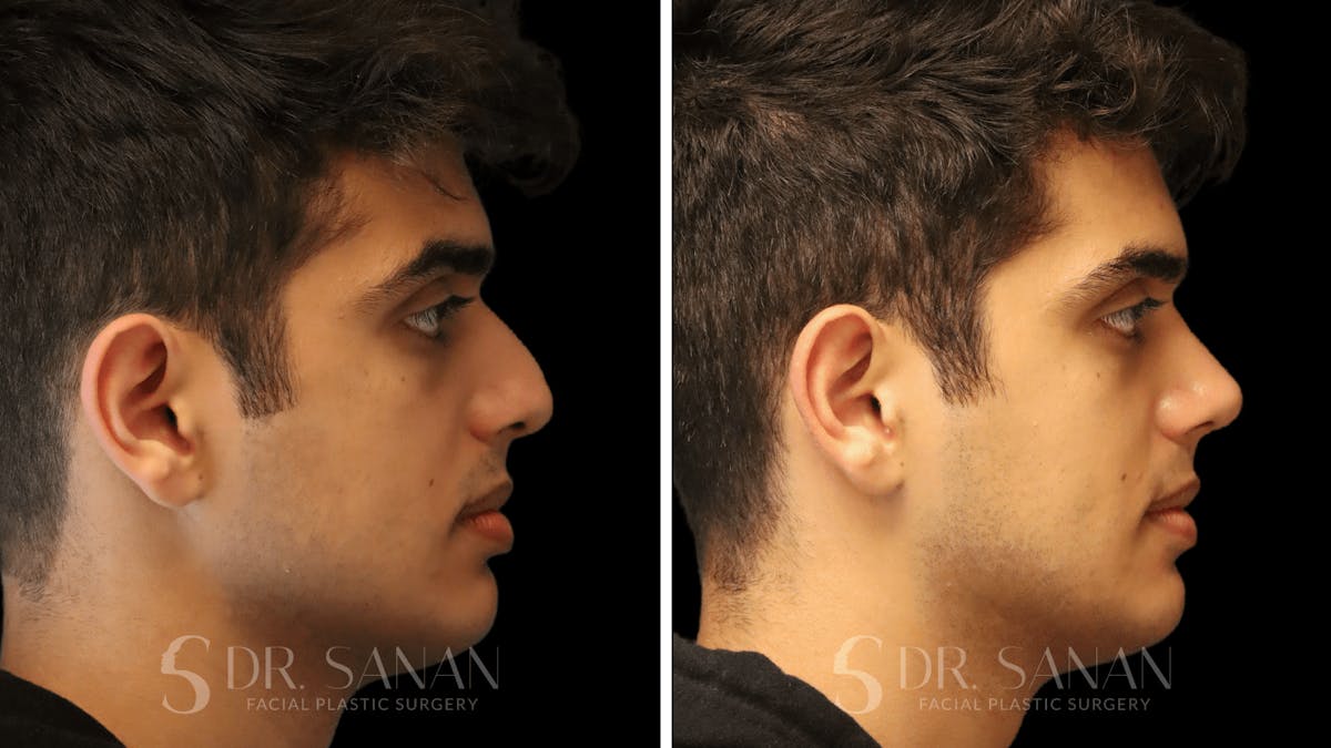 Rhinoplasty Before & After Gallery - Patient 207835 - Image 1