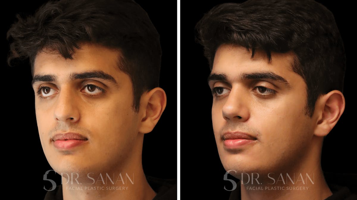 Rhinoplasty Before & After Gallery - Patient 207835 - Image 5