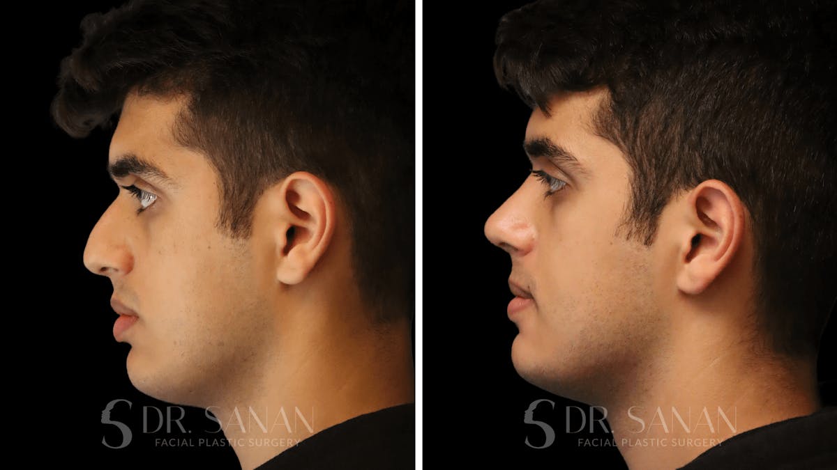 Rhinoplasty Before & After Gallery - Patient 207835 - Image 2