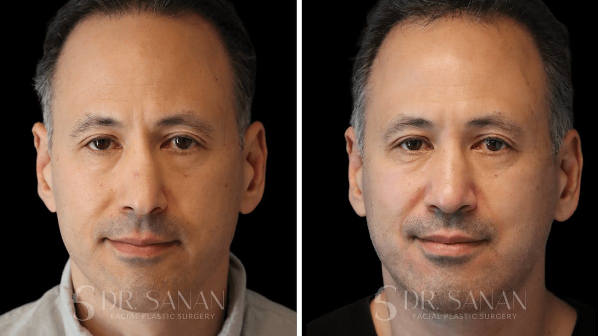 Rhinoplasty Before & After Gallery - Patient 164478 - Image 3