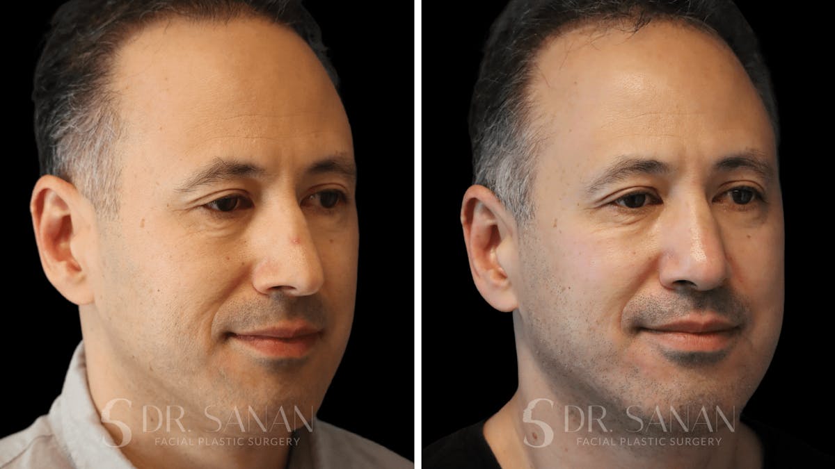 Rhinoplasty Before & After Gallery - Patient 164478 - Image 4