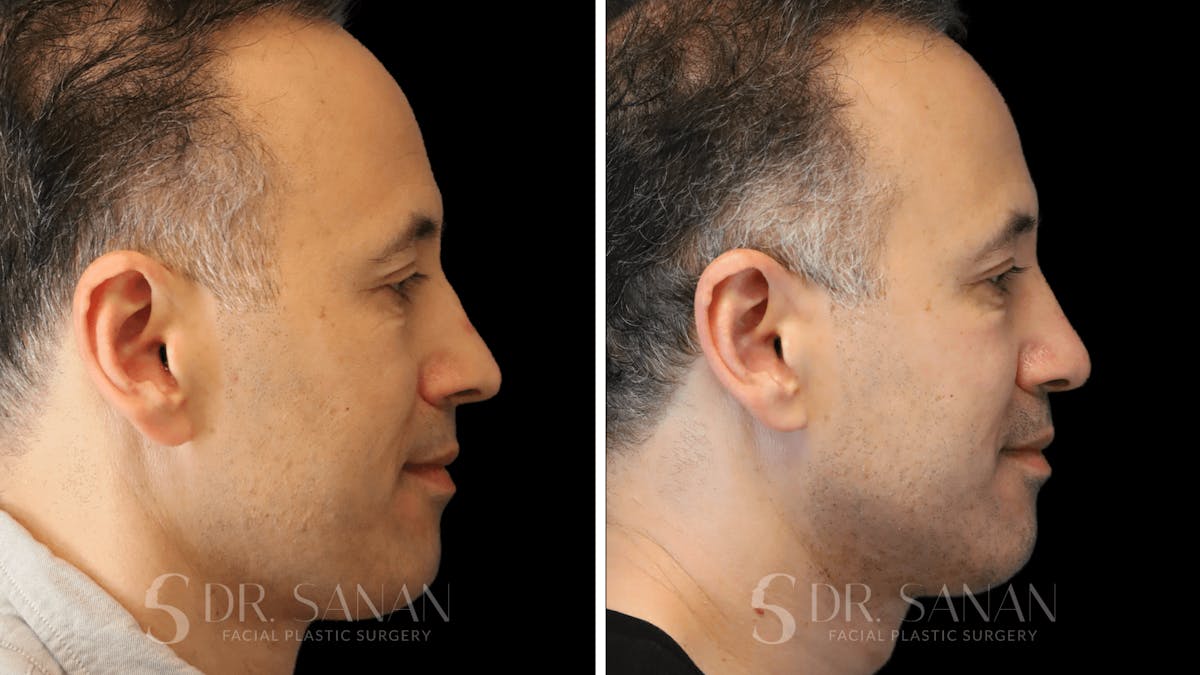 Rhinoplasty Before & After Gallery - Patient 164478 - Image 1