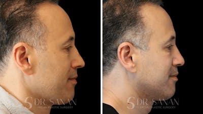 Rhinoplasty Before & After Gallery - Patient 164478 - Image 1