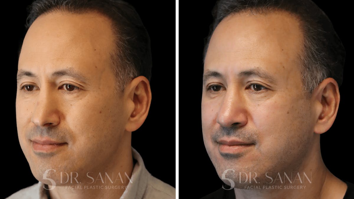 Rhinoplasty Before & After Gallery - Patient 164478 - Image 5