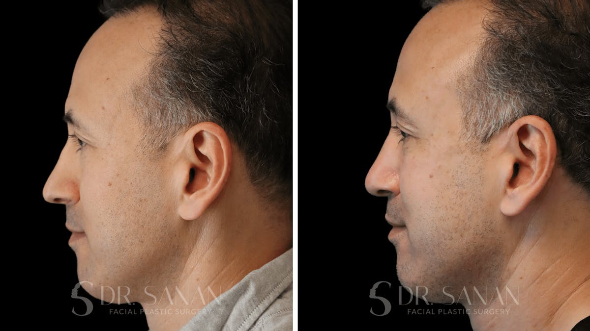 Rhinoplasty Before & After Gallery - Patient 164478 - Image 2