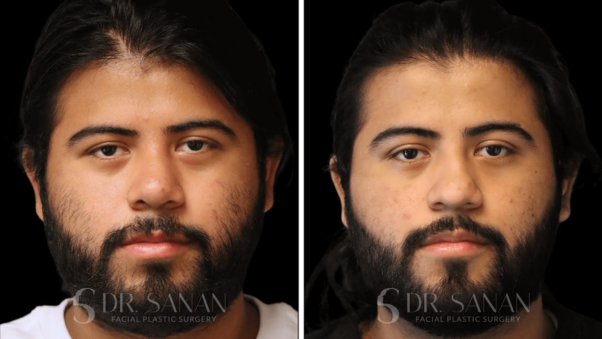 Rhinoplasty Before & After Gallery - Patient 296359 - Image 3