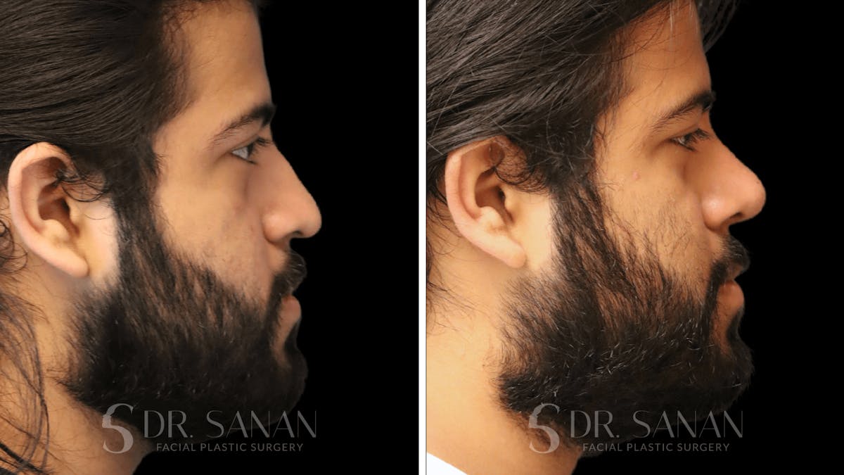 Rhinoplasty Before & After Gallery - Patient 296359 - Image 1