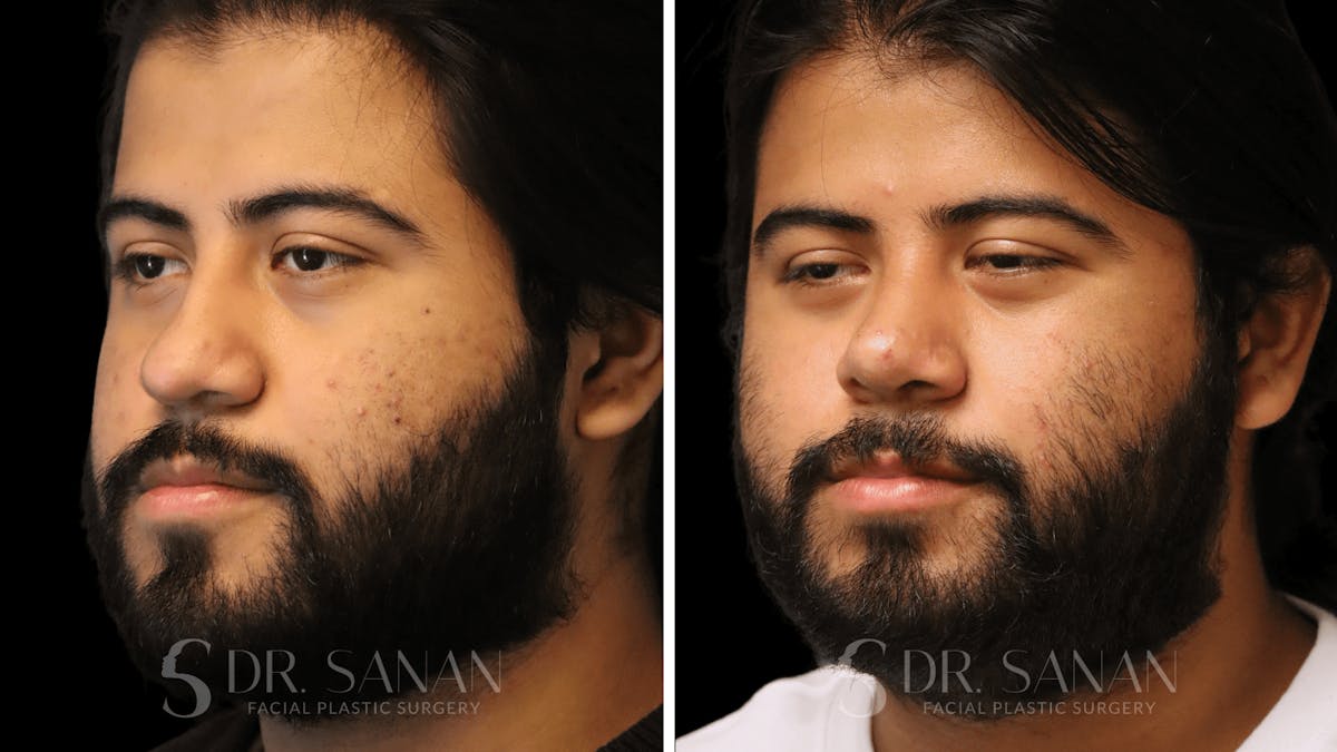 Rhinoplasty Before & After Gallery - Patient 296359 - Image 5