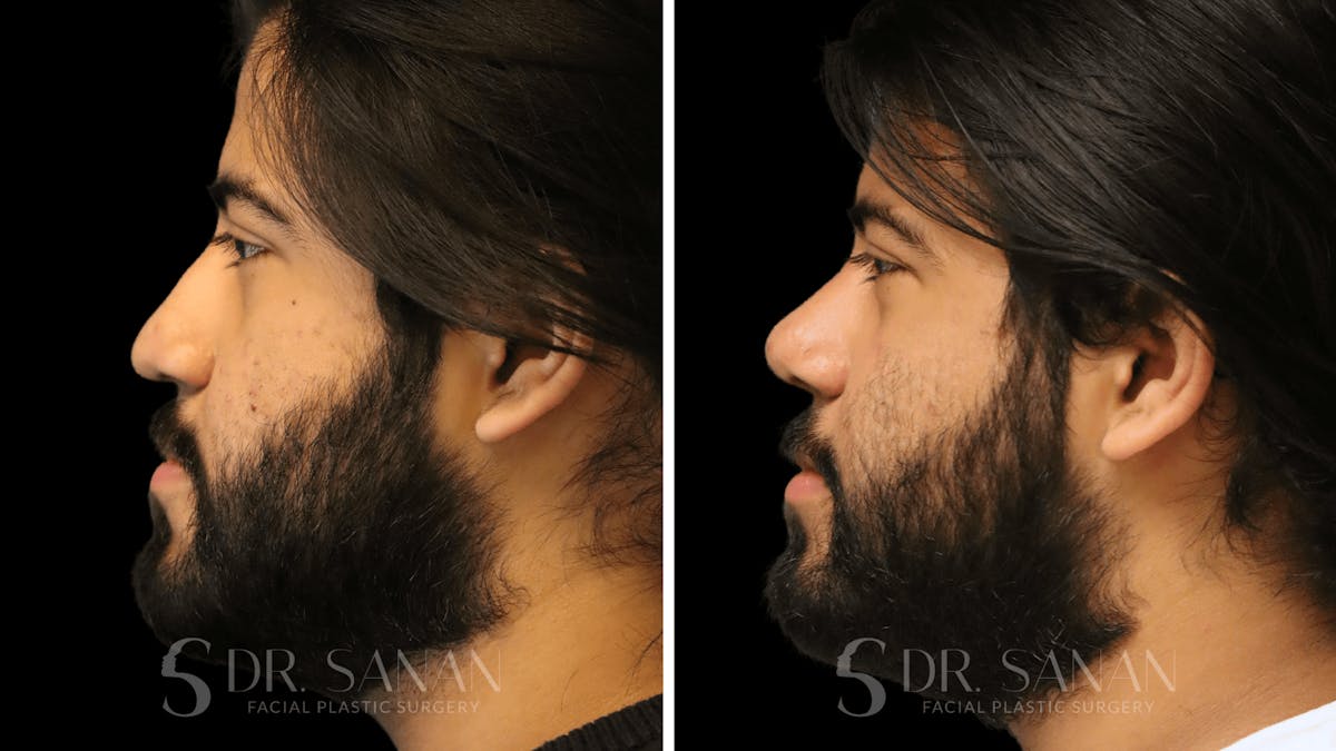 Rhinoplasty Before & After Gallery - Patient 296359 - Image 2