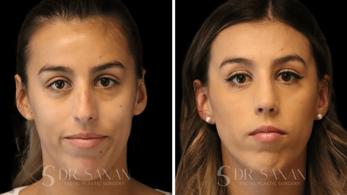 Rhinoplasty Before & After Gallery - Patient 167792 - Image 3