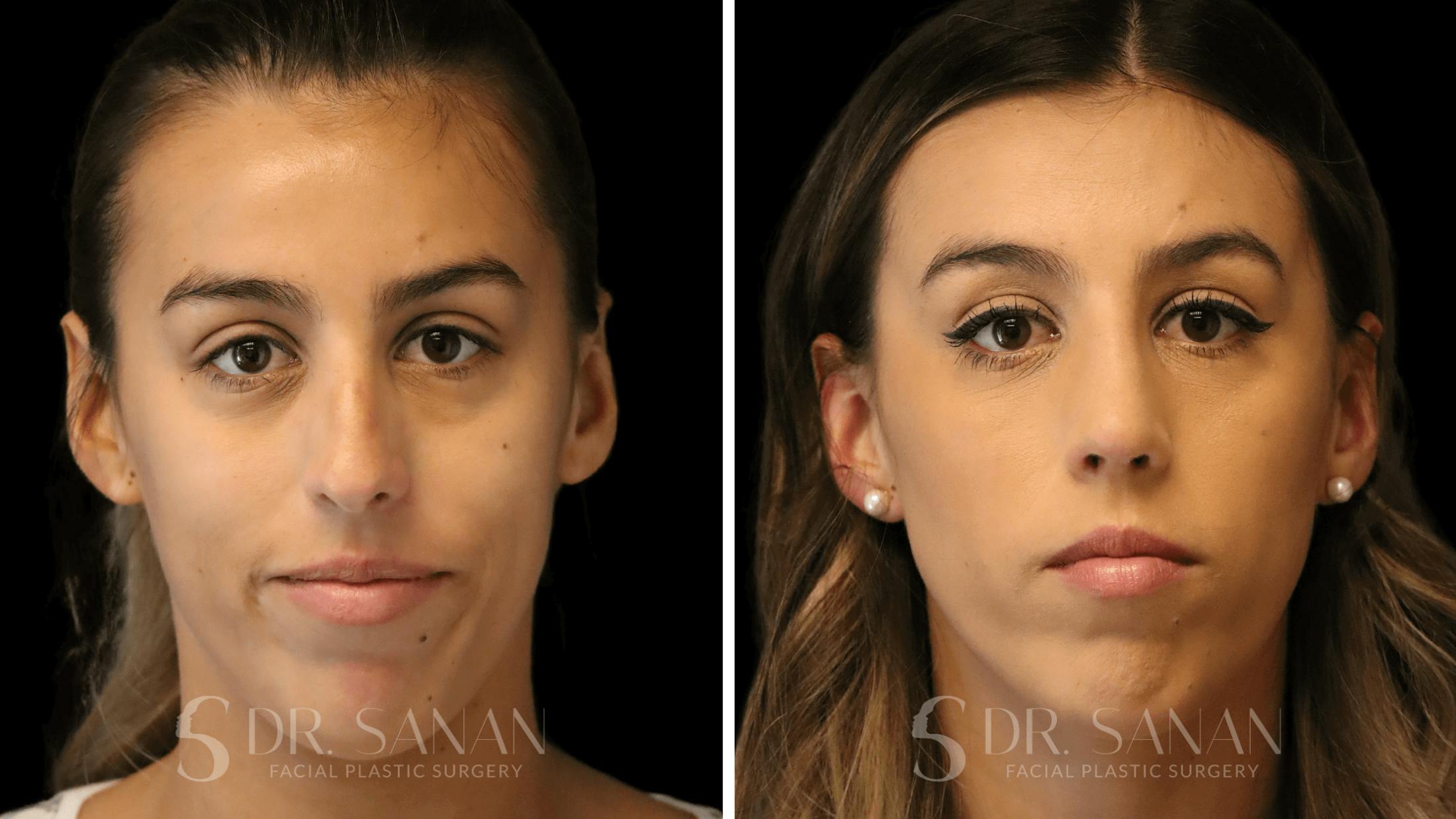 Rhinoplasty Before & After Gallery - Patient 167792 - Image 3