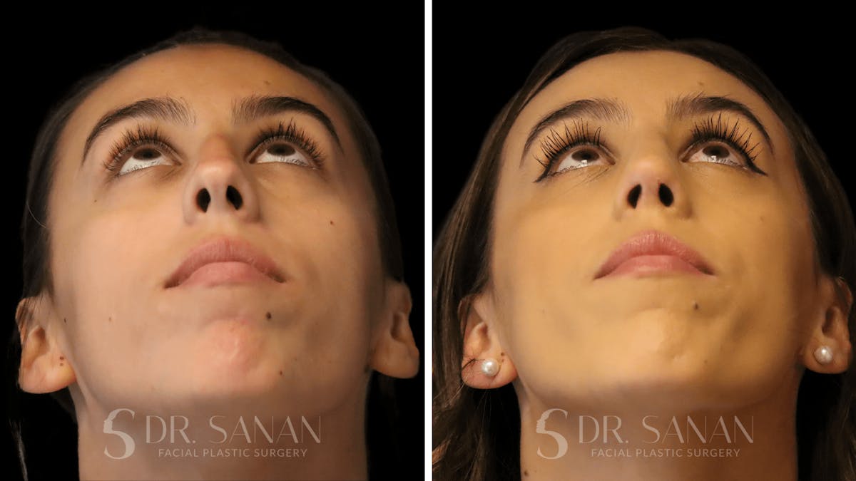 Rhinoplasty Before & After Gallery - Patient 167792 - Image 4