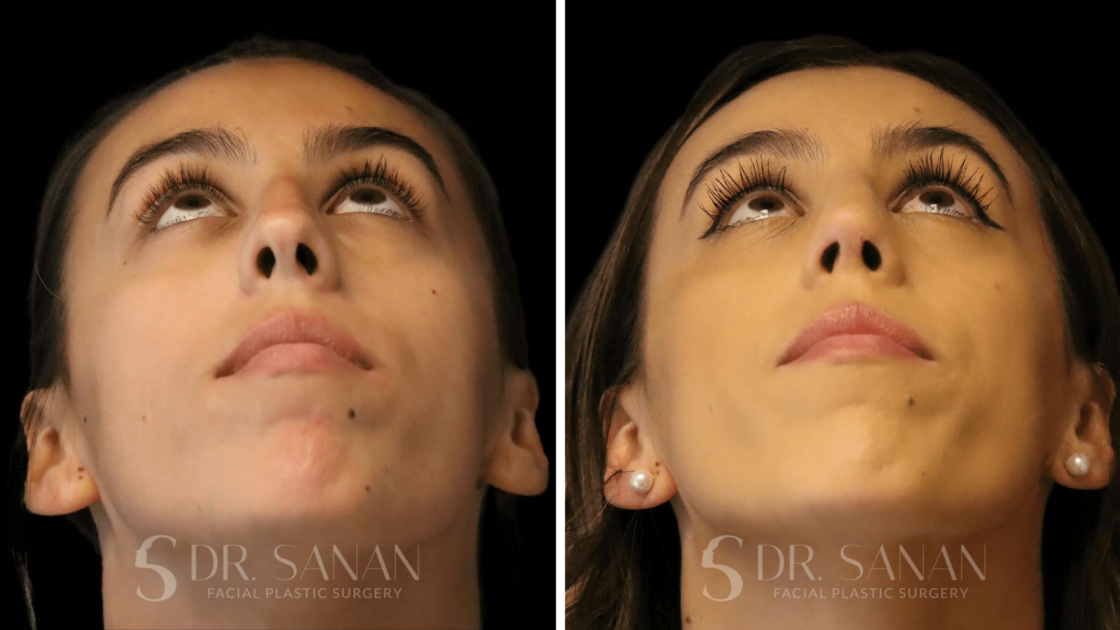 Rhinoplasty Before & After Gallery - Patient 167792 - Image 4