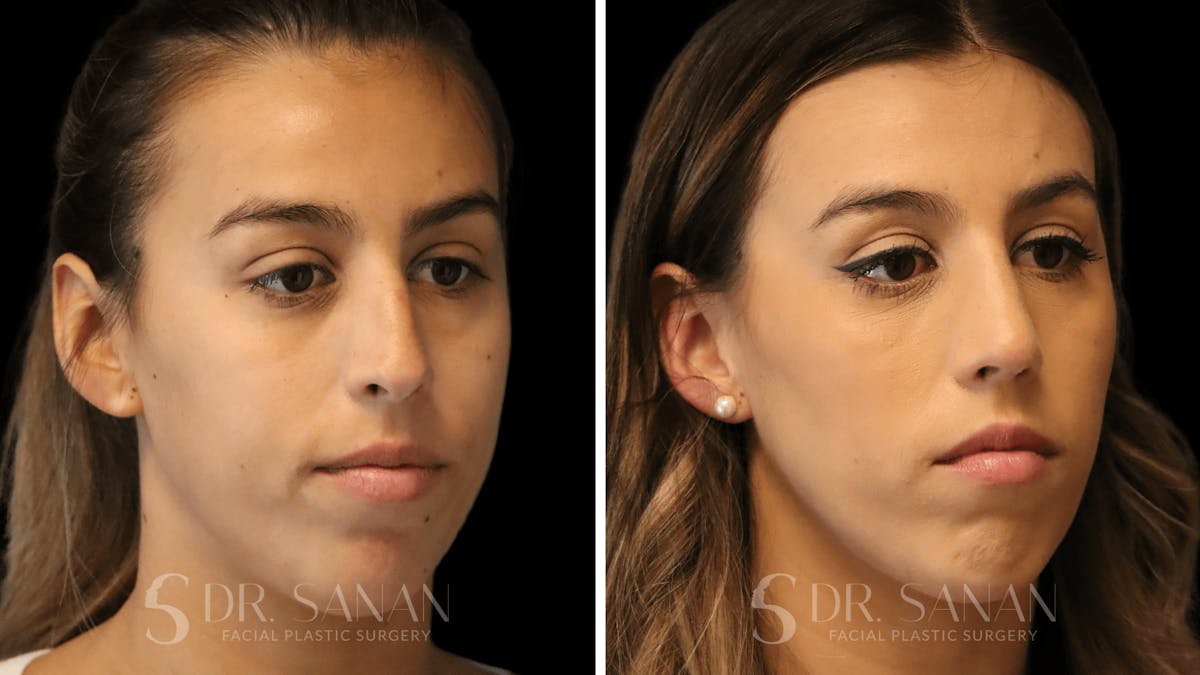 Rhinoplasty Before & After Gallery - Patient 167792 - Image 5