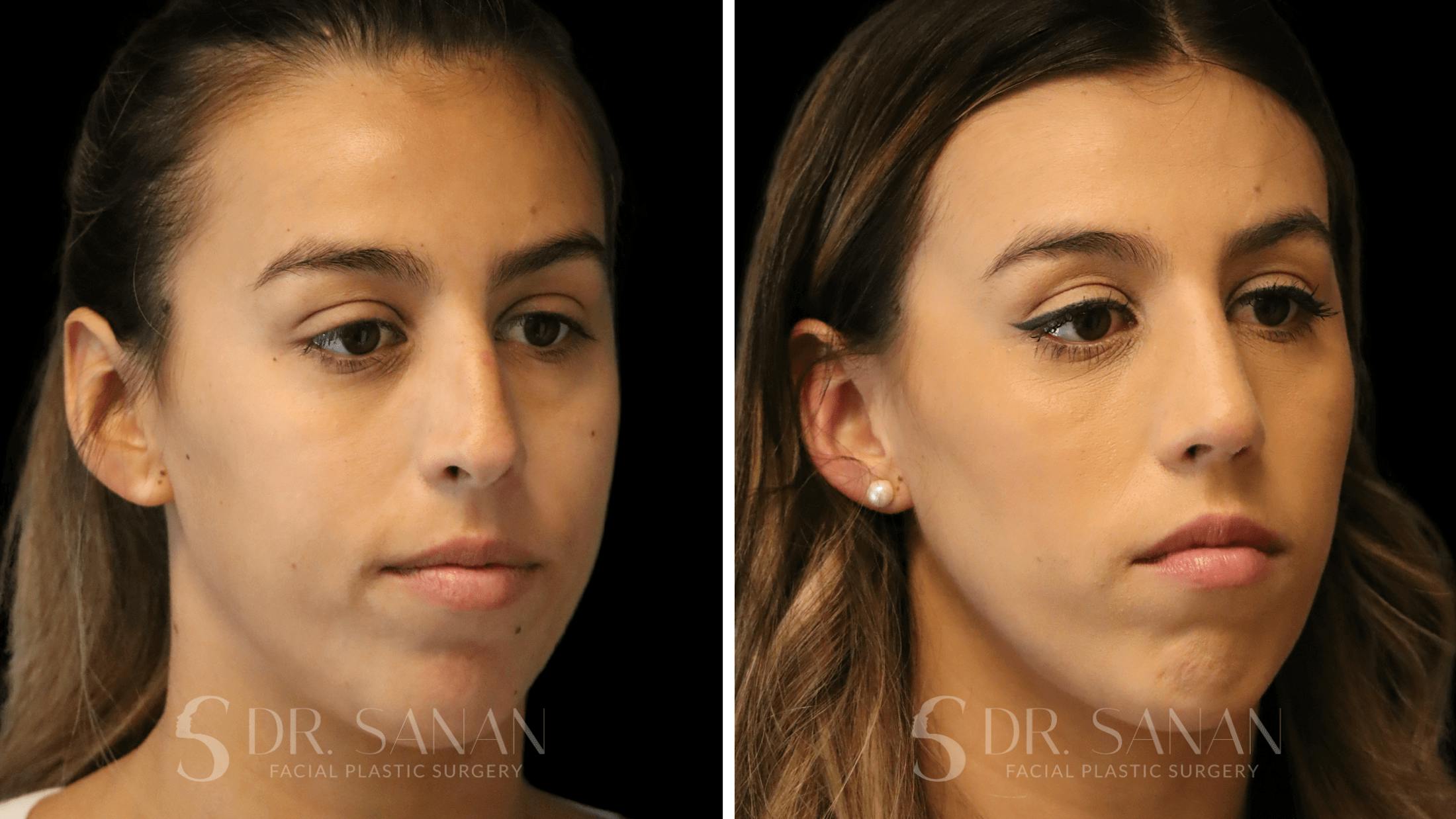 Rhinoplasty Before & After Gallery - Patient 167792 - Image 5