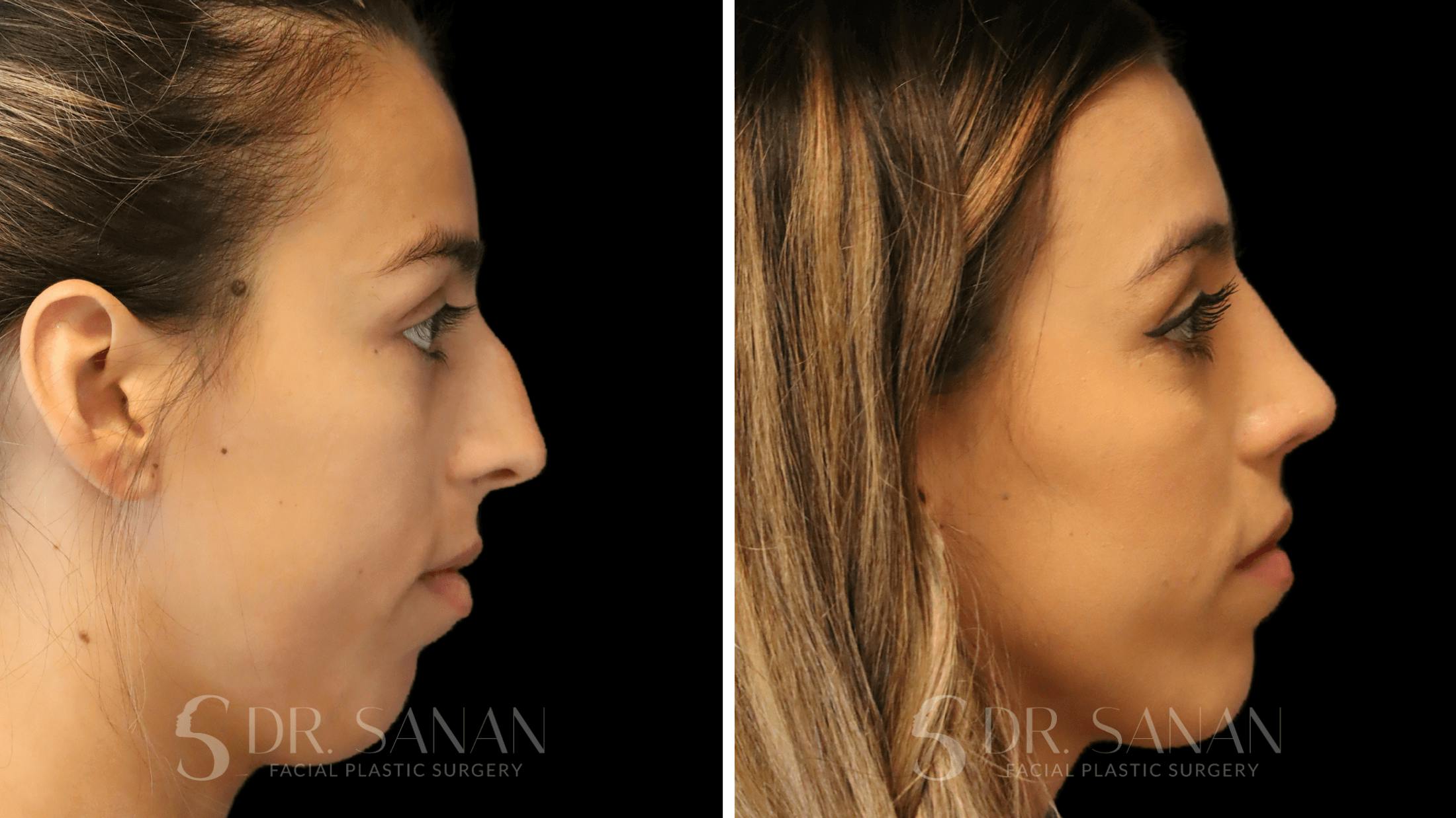 Rhinoplasty Before & After Gallery - Patient 167792 - Image 1