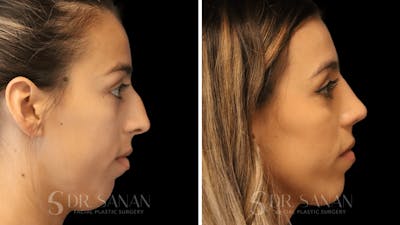 Rhinoplasty Before & After Gallery - Patient 167792 - Image 1