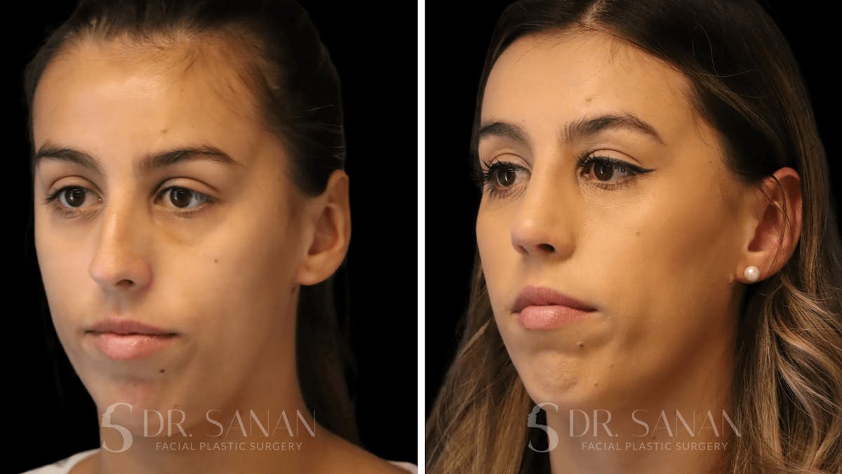 Rhinoplasty Before & After Gallery - Patient 167792 - Image 6