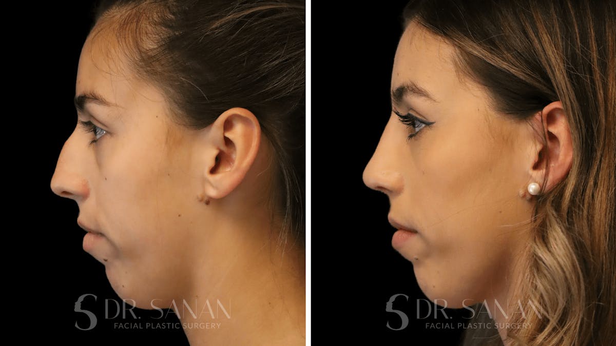 Rhinoplasty Before & After Gallery - Patient 167792 - Image 2