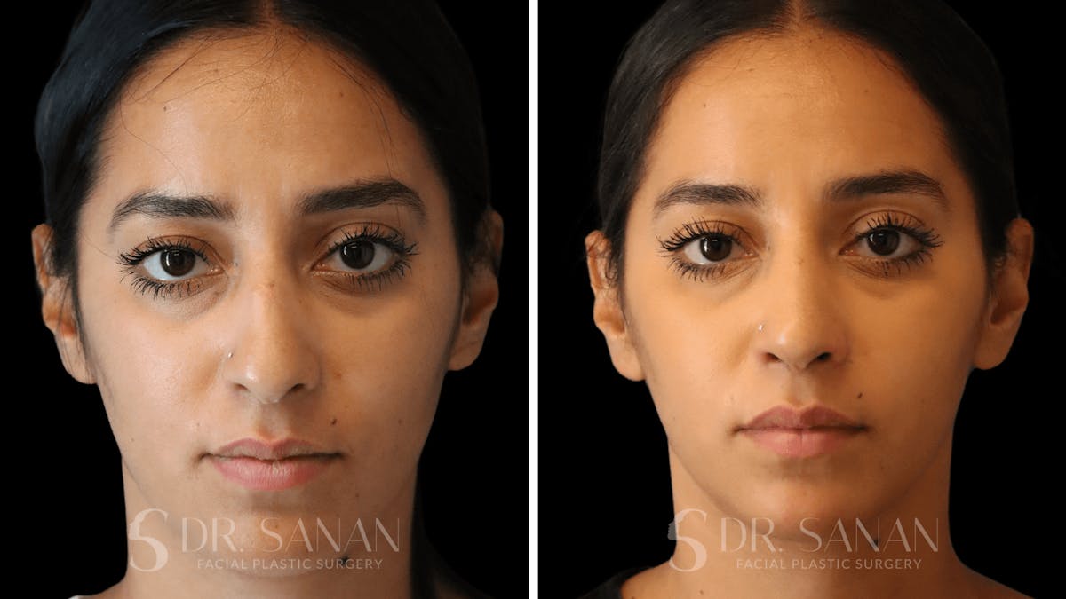 Rhinoplasty Before & After Gallery - Patient 194470 - Image 3
