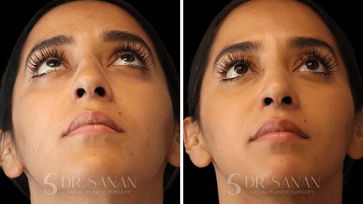 Rhinoplasty Before & After Gallery - Patient 194470 - Image 4