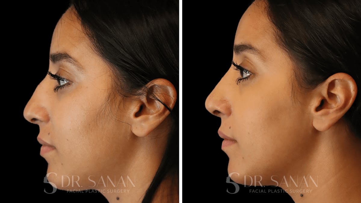 Rhinoplasty Before & After Gallery - Patient 194470 - Image 2
