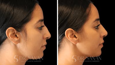 Rhinoplasty Before & After Gallery - Patient 194470 - Image 1