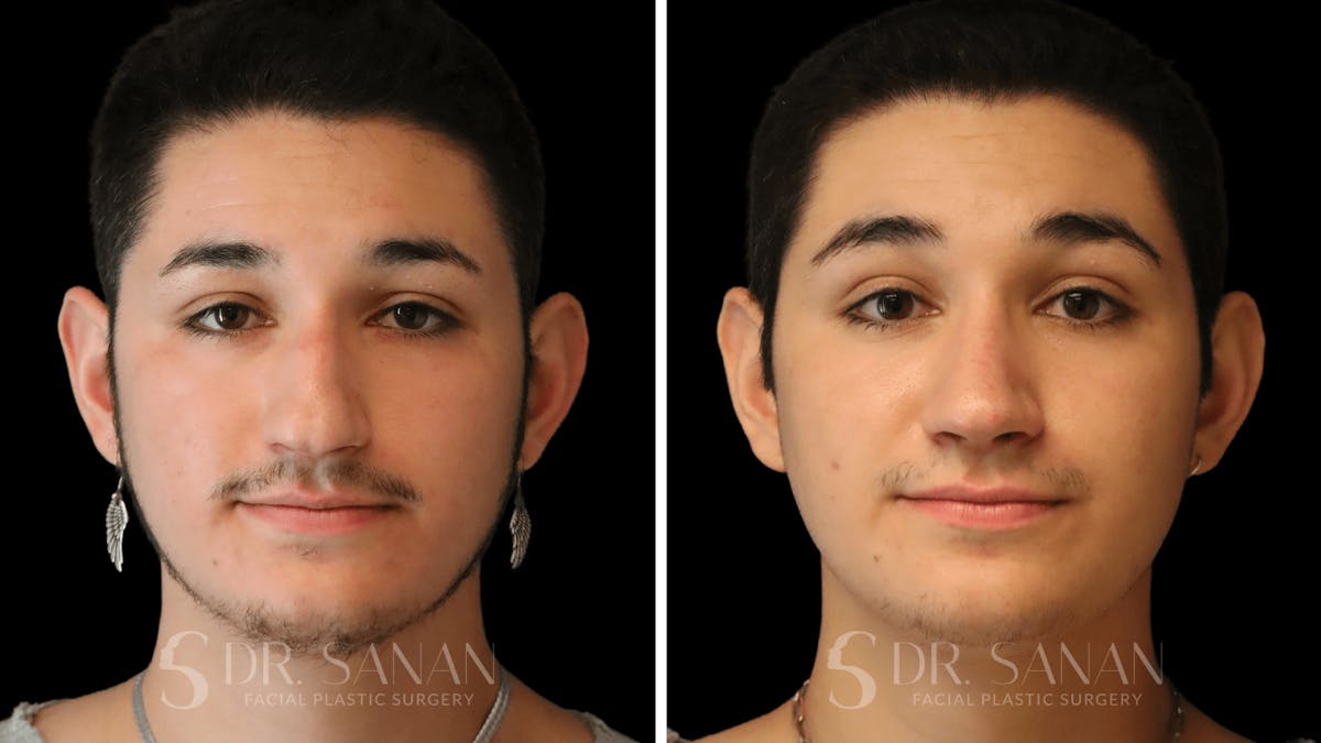 Rhinoplasty Before & After Gallery - Patient 258437 - Image 3