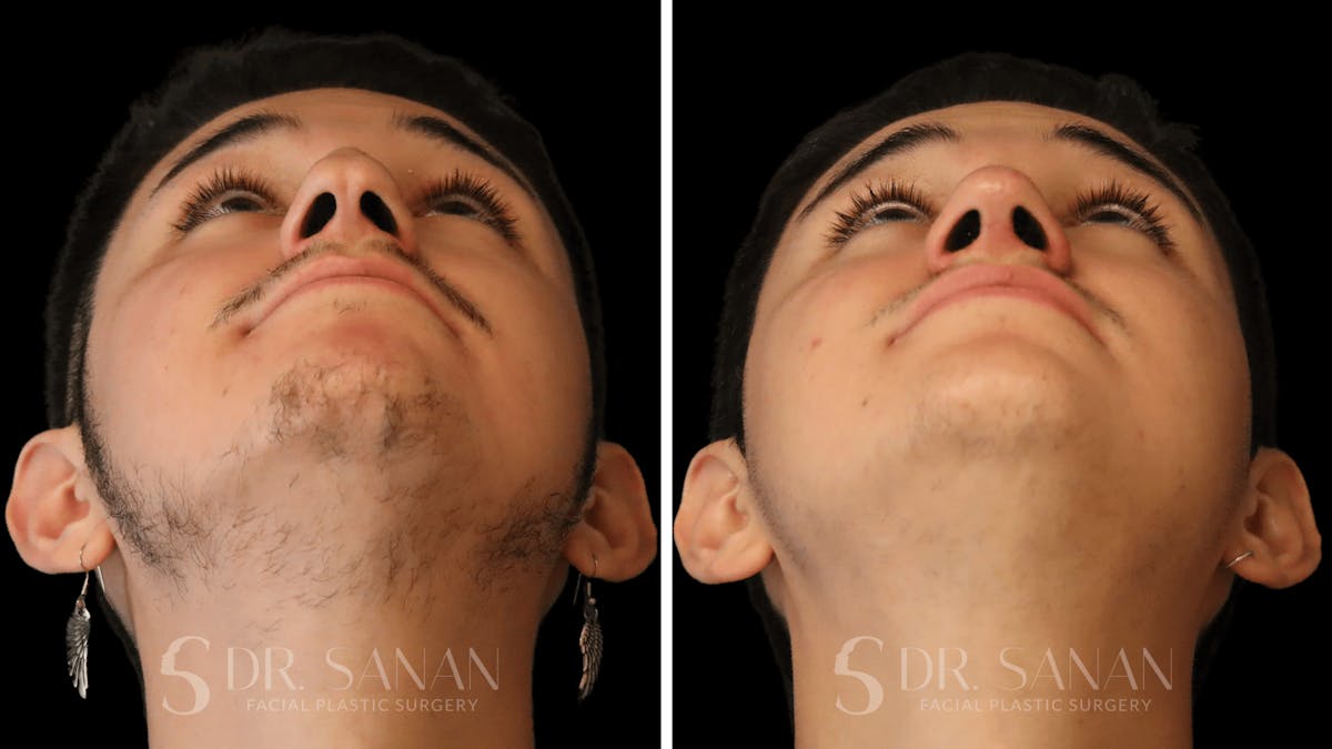 Rhinoplasty Before & After Gallery - Patient 258437 - Image 4