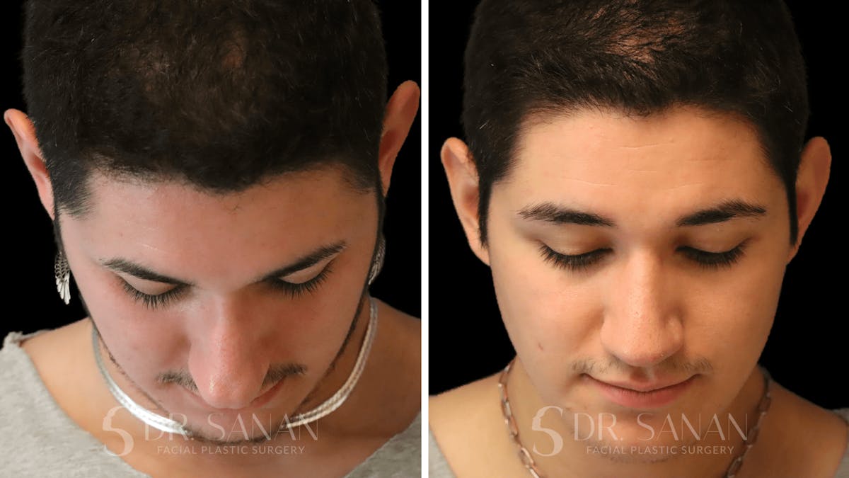 Rhinoplasty Before & After Gallery - Patient 258437 - Image 5