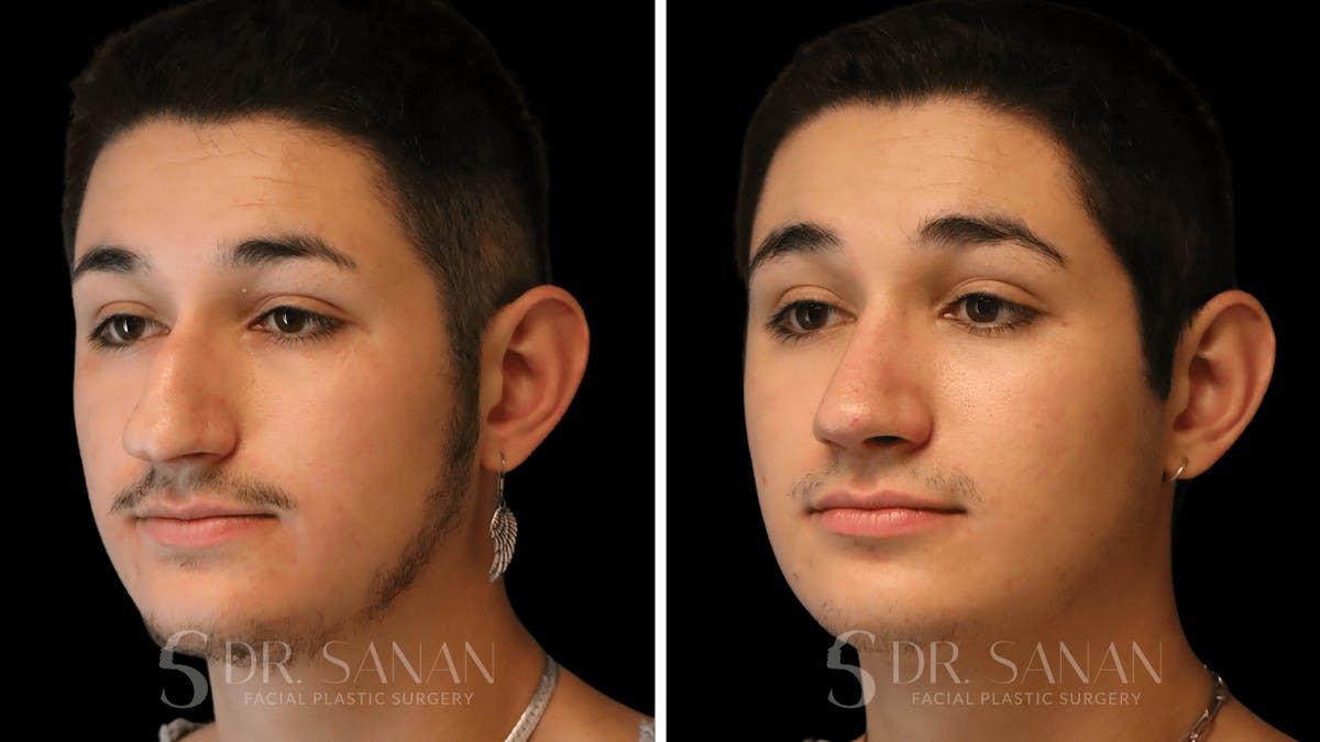 Rhinoplasty Before & After Gallery - Patient 258437 - Image 6