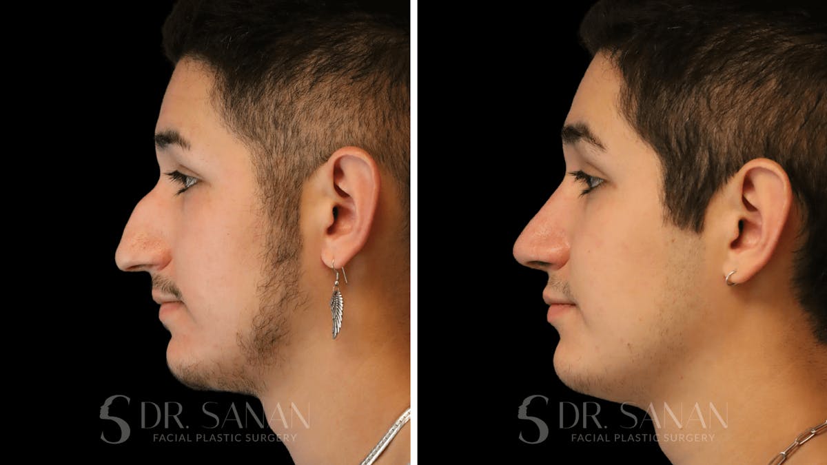 Rhinoplasty Before & After Gallery - Patient 258437 - Image 7