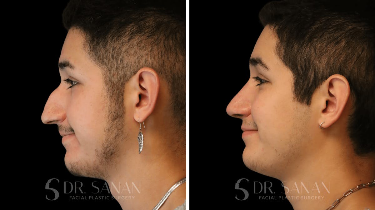 Rhinoplasty Before & After Gallery - Patient 258437 - Image 2
