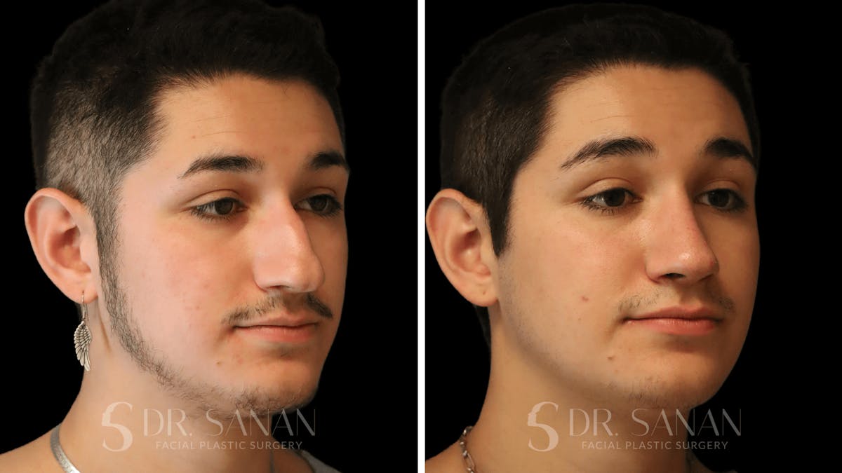 Rhinoplasty Before & After Gallery - Patient 258437 - Image 8
