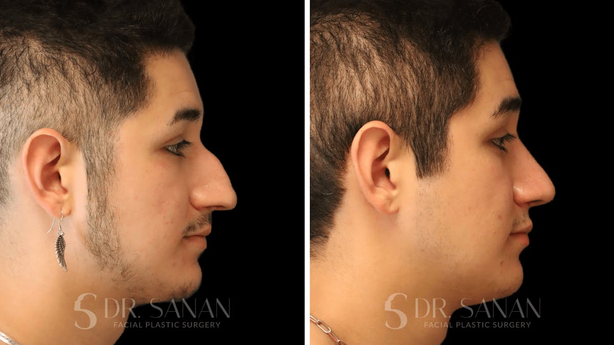 Rhinoplasty Before & After Gallery - Patient 258437 - Image 9