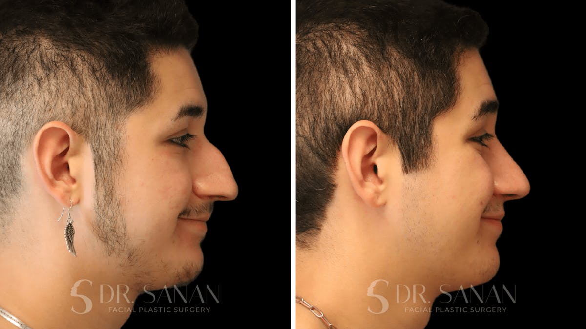 Rhinoplasty Before & After Gallery - Patient 258437 - Image 1