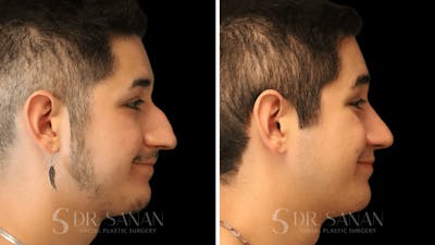 Rhinoplasty Before & After Gallery - Patient 258437 - Image 1