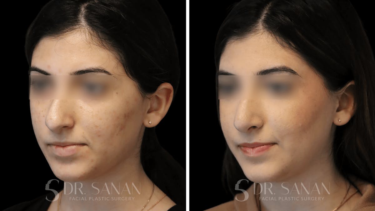 Rhinoplasty Before & After Gallery - Patient 195566 - Image 3
